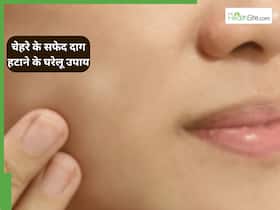 त्वचा के सफेद दाग को दूर करने के लिए अपनाएं ये 3 घरेलू नुस्खें
