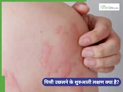पित्ती उछलने की शुरुआत कैसे होती है? जानें इसे पहचानने के 5 संकेत