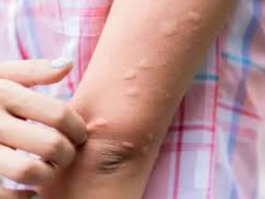 पित्ती उछलने की शुरुआत कैसे होती है? जानें इसे पहचानने के 5 संकेत