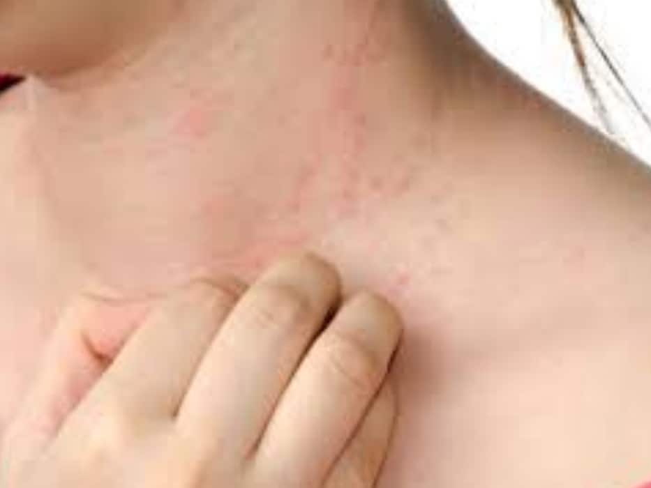 पित्ती उछलने की शुरुआत कैसे होती है? जानें इसे पहचानने के 5 संकेत