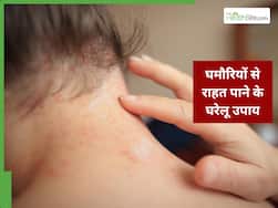 बच्चों को घमौरियां होने पर क्या करें? जानें असरदार घरेलू उपाय जिससे खुजली और जलन होगी कम