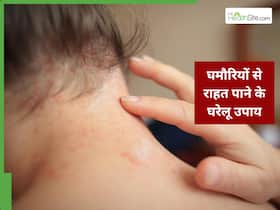बच्चों को घमौरियां होने पर क्या करें? जानें असरदार घरेलू उपाय जिससे खुजली और जलन होगी कम
