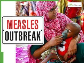 Bangladesh Measles Outbreak: 145 dead, 533 hospitalised in 24 hours - Should India be worried about cross-border transmission? Bangladesh Measles Outbreak: 145 dead, 533 hospitalised in 24 hours - Should India be worried about cross-border transmission?
