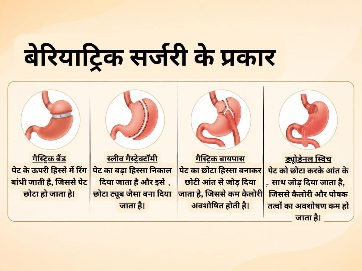 बेरियाट्रिक सर्जरी के प्रकार क्या हैं?