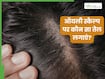 ऑयली स्कैल्प पर कौन सा तेल लगाएं?
