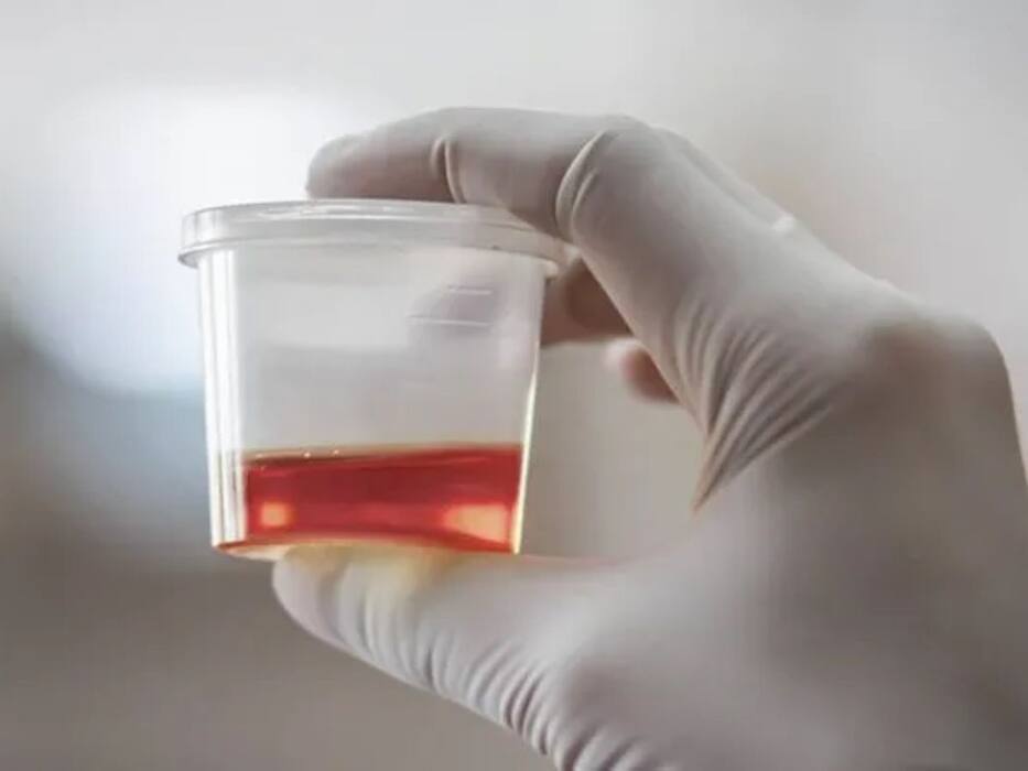 5 urine changes that could signal early kidney damage you shouldn’t ignore