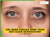 World Health Day 2026: Are dark circles more than just sleep deprivation? #FitIndiaHitIndia