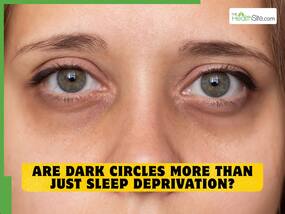 World Health Day 2026: Are dark circles more than just sleep deprivation? World Health Day 2026: Are dark circles more than just sleep deprivation?