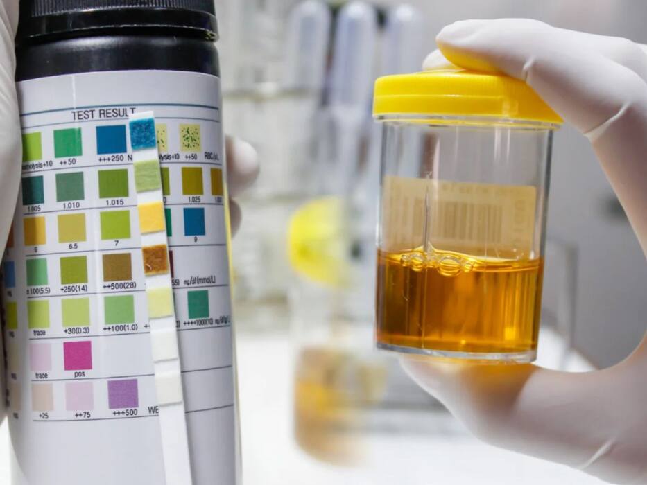 5 urine changes that could signal early kidney damage you shouldn’t ignore