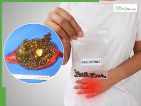 Gallstones symptoms: From dark urine colour to recurrent UTIs - What happens when the gallbladder is not functioning?
