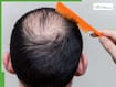 5 easy summer hacks to regrow hair on visible scalp