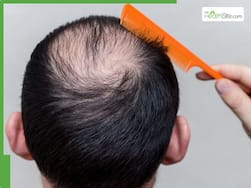 5 easy summer hacks to regrow hair on visible scalp