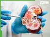 Why kidney diseases are increasing rapidly and the early warning signs you must never ignore