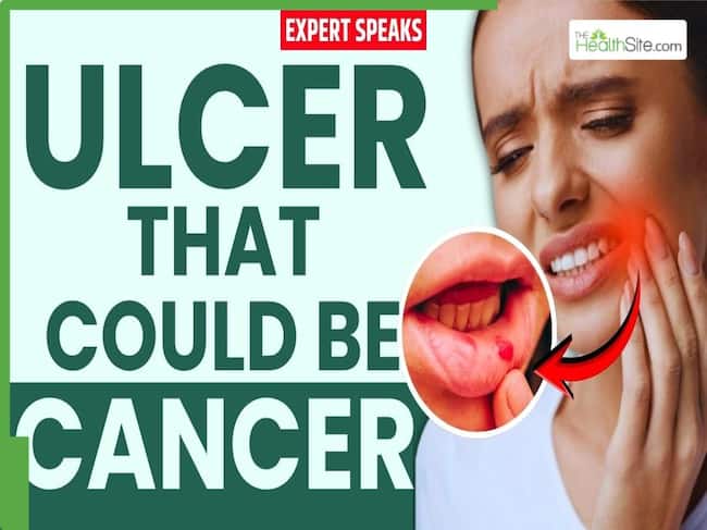Is it just a mouth ulcer? Expert explains early symptoms of oral cancer that shouldn't be ignored | Watch Video