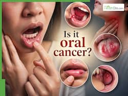 Oral cancer symptoms: 7 early warning signs in the mouth and tongue, according to an oncologist