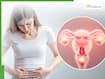 PCOS in women after 25: Gynaecologist explains early warning signs your hormones are completely out of balance
