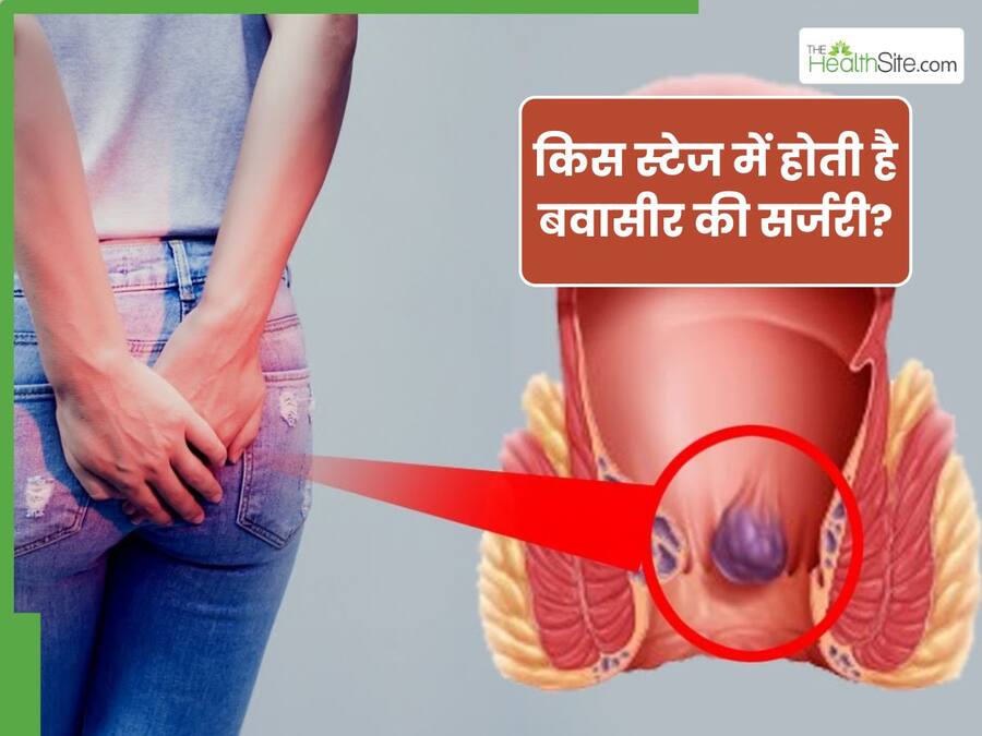 बवासीर का ऑपरेशन कब करवाना चाहिए? जानें, पाइल्स के खतरनाक लक्षण