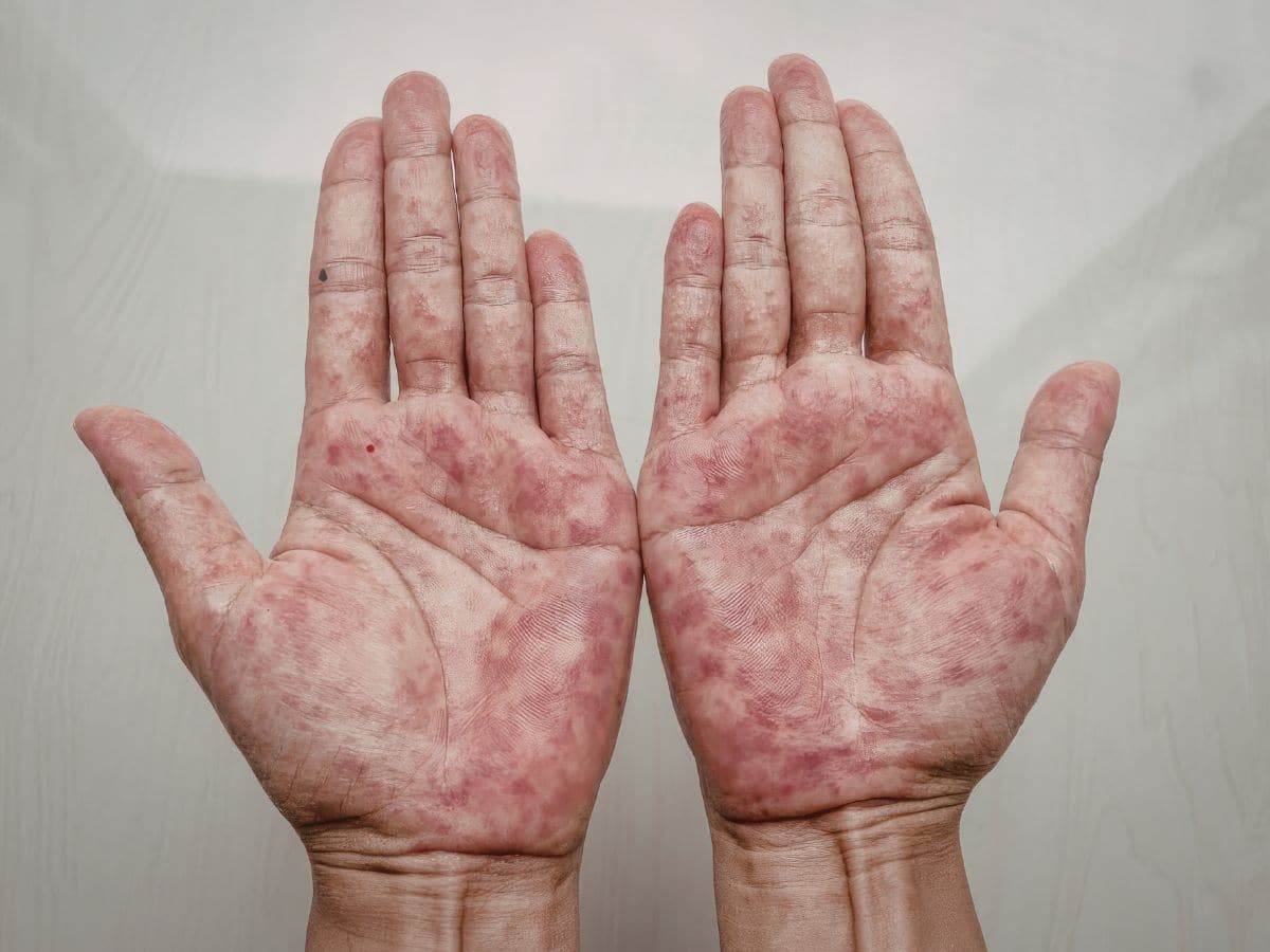 Skin rash Causes