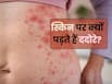 त्वचा पर ददोरा होने का क्या कारण है? जानते हैं 5 कारण