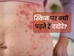 त्वचा पर ददोरा होने का क्या कारण है? जानते हैं 5 कारण