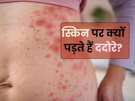 त्वचा पर ददोरा होने का क्या कारण है? जानते हैं 5 कारण