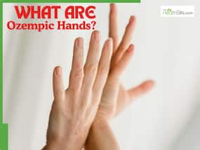 What are    Ozempic Hands    and why is everyone talking about them?