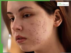 World Health Day 2026: How acne, dullness and pigmentation signal hidden health issues #FitIndiaHitIndia