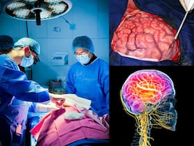 29 साल के युवा में ब्रेन ट्यूमर का सफल इलाज, बिना बेहोश किए की गई सर्जरी