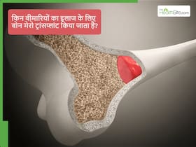 बोन मैरो ट्रांसप्लांट कैसे होता है और किन बीमारियों के इलाज में किया जाता है? बोन मैरो ट्रांसप्लांट कैसे होता है और किन बीमारियों के इलाज में किया जाता है?