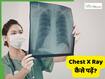चेस्ट एक्स-रे की रिपोर्ट कैसे पढ़ें? Report से क्या-क्या पता चलता है