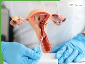 Hormonal imbalance or a warning sign? Doctor explains why irregular periods and postmenopausal bleeding could indicate endometrial cancer