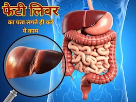 फैटी लिवर की पहली स्टेज में कौन से लक्षण दिखते हैं? डॉक्टर ने बताया रिपोर्ट पॉजिटिव आने पर कैसे रखें अपना ध्यान