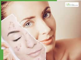 Summer skincare tips: 5 overnight natural remedies for glowing, acne-free skin