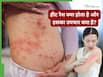 हीट रैश क्या होता है? डॉक्टर से जानें इस समस्या को ठीक करने का तरीका