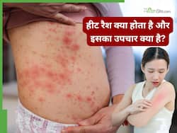 हीट रैश क्या होता है? डॉक्टर से जानें इस समस्या को ठीक करने का तरीका