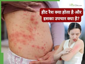 हीट रैश क्या होता है? डॉक्टर से जानें इस समस्या को ठीक करने का तरीका