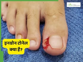 क्या है नाखून से जुड़ी समस्या "इनग्रोन टोनेल"? जानें कब पड़ती है सर्जरी की जरूरत