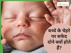 नवजात शिशुओं के चेहरे पर सफेद दाने क्यों होते हैं? क्या ये मिलिया हैं?