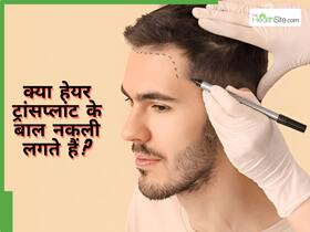 क्या हेयर ट्रांसप्लांट के बाद बाल नकली लगते हैं? एक डॉक्टर की नजर से जानें पूरी सच्चाई