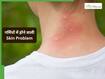 सनबर्न से लेकर पिंपल्स तक गर्मियों में होती हैं ये 5 Skin Problem, AIIMs के डॉक्टर से जानें इसका इलाज