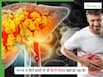 NAFLD: शराब न पीने वालों में भी फैटी लिवर क्यों होता है? जानिए कारण और लक्षण