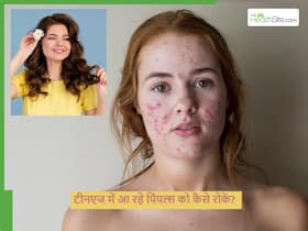 क्यों टीनएज में ज्यादा पिंपल आने लगते हैं और इससे कैसे बचा जाए, डर्मेटोलॉजिस्ट से जानें