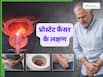 प्रोस्टेट कैंसर के शुरुआती लक्षण क्या होते हैं? जानें स्थिति कब बनती है गंभीर