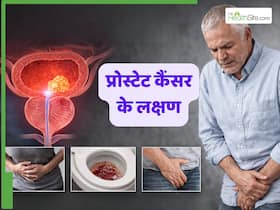 प्रोस्टेट कैंसर के शुरुआती लक्षण क्या होते हैं? जानें स्थिति कब बनती है गंभीर