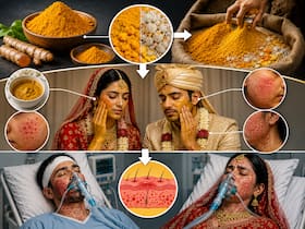 मिलावटी हल्दी ने दूल्हे को पहुंचाया वेंटिलेटर पर, दूल्हा-दुल्हन दोनों को हुई गंभीर स्किन एलर्जी
