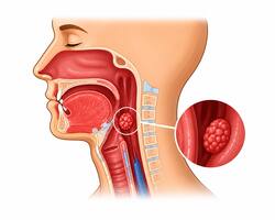 HPV के कारण भारतीयों में बढ़ रहे हैं गले के कैंसर के मामले, इन 5 लक्षणों को आज ही पहचानें