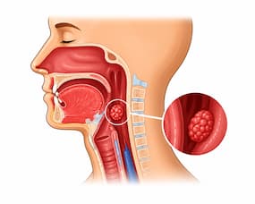 HPV के कारण भारतीयों में बढ़ रहे हैं गले के कैंसर के मामले, इन 5 लक्षणों को आज ही पहचानें