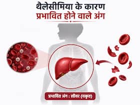 थैलेसीमिया से कौन सा अंग प्रभावित होता है? VIDEO में डॉक्टर बता रहे हैं इसके बारे में