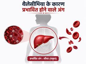 थैलेसीमिया से कौन सा अंग प्रभावित होता है? VIDEO में डॉक्टर बता रहे हैं इसके बारे में