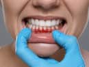 Could gum disease be treated without antibiotics? Study offers promising new answer